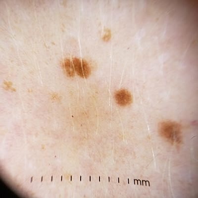 Skin close-up showing multiple dark spots.