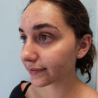 Person with acne looking to the side.