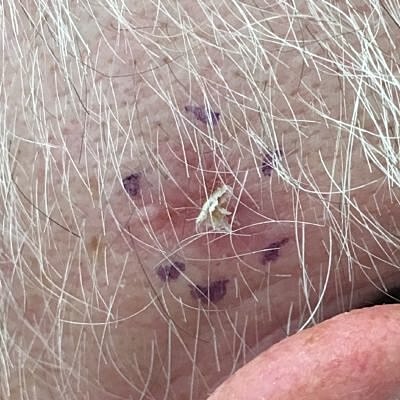 Skin with irritation and a small foreign object