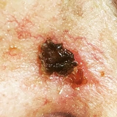 Skin lesion with dark scab and redness.