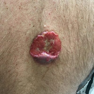 Skin lesion on a person's leg.