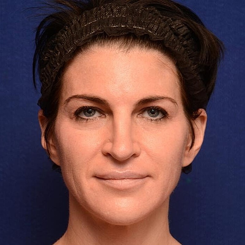 Xeomin Before & After