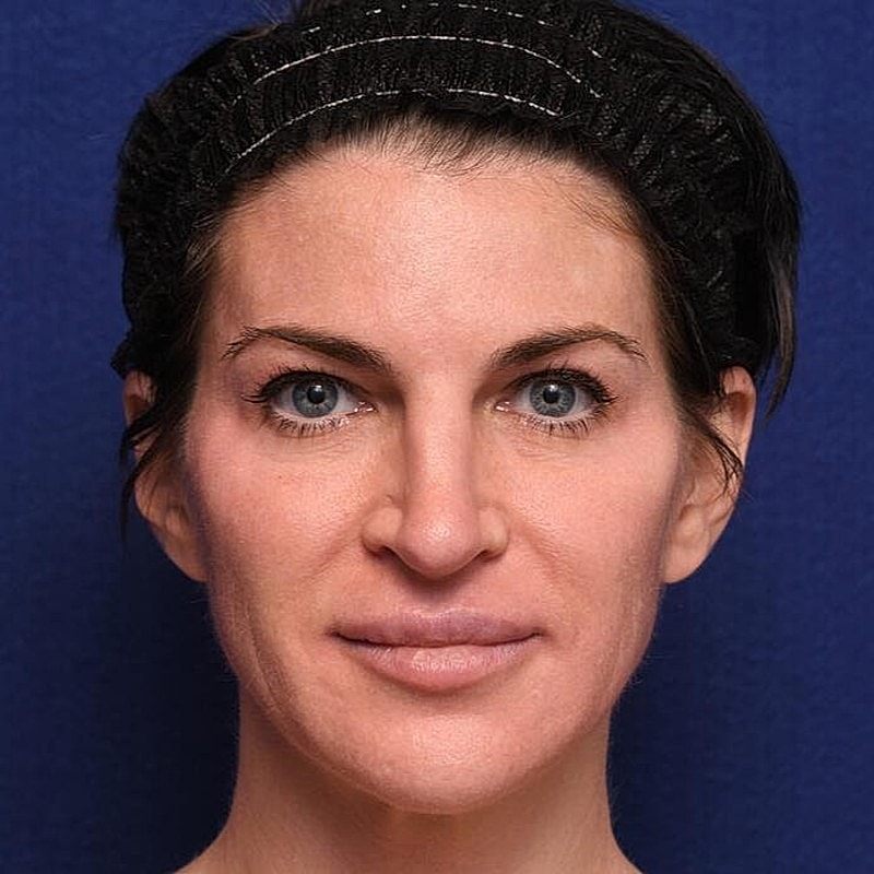 Xeomin Before & After