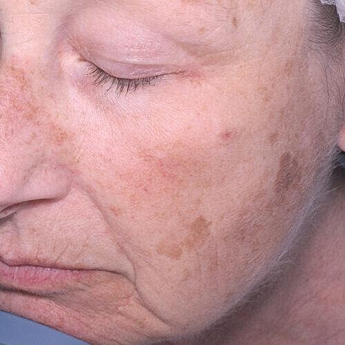 Halo Hybrid Fractional Laser Before & After