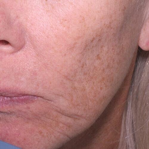 Halo Hybrid Fractional Laser Before & After