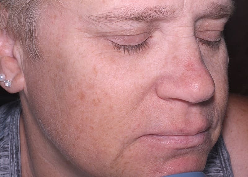 Halo Hybrid Fractional Laser Before & After