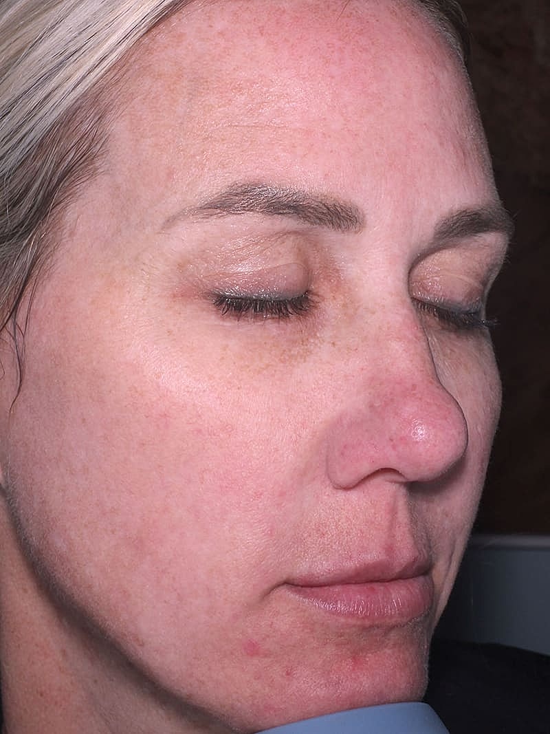 Halo Hybrid Fractional Laser Before & After