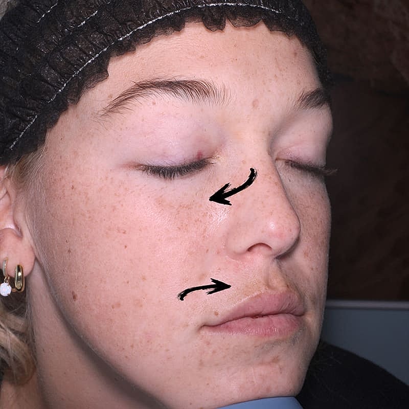 Halo Hybrid Fractional Laser Before & After