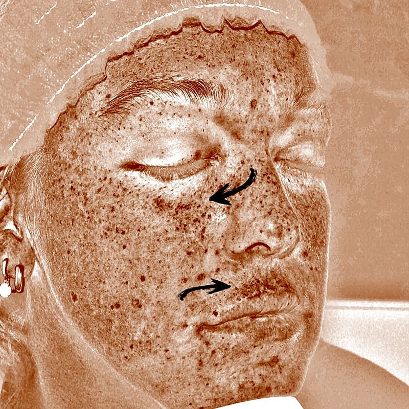 Halo Hybrid Fractional Laser Before & After