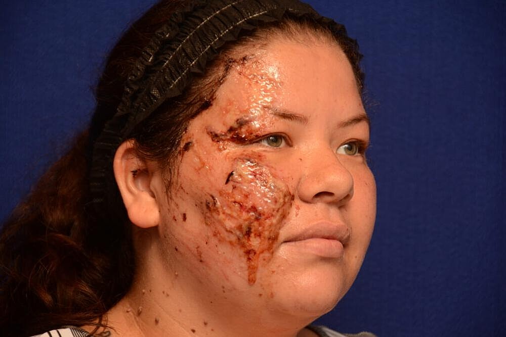 Scar Therapy Before & After