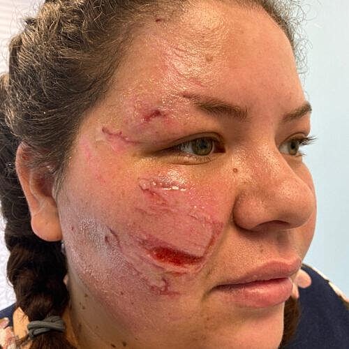 Scar Therapy Before & After