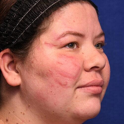 Scar Therapy Before & After