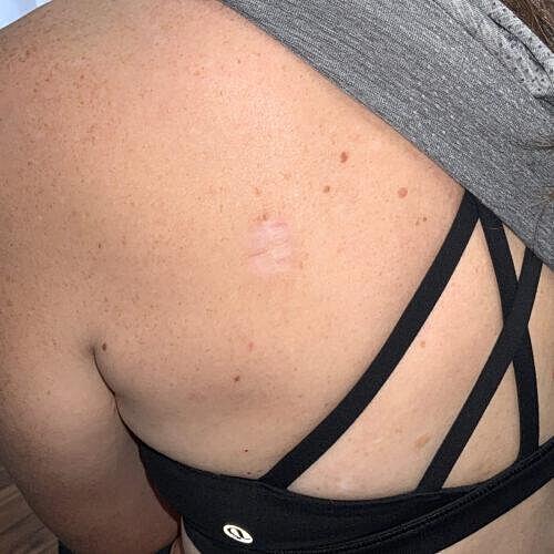 Scar Therapy Before & After