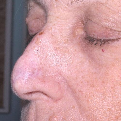 Scar Therapy Before & After