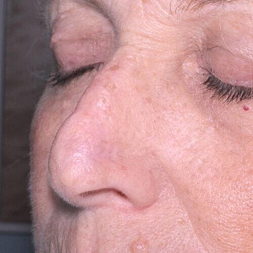 Scar Therapy Before & After