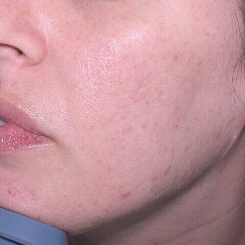 Scar Therapy Before & After