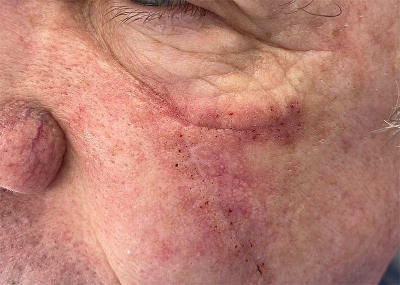 Scar Therapy Before & After