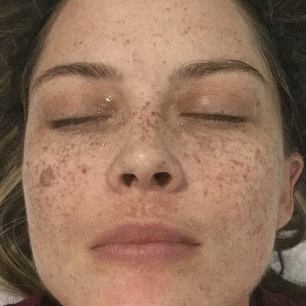 Broadband Light Bbl Before & After