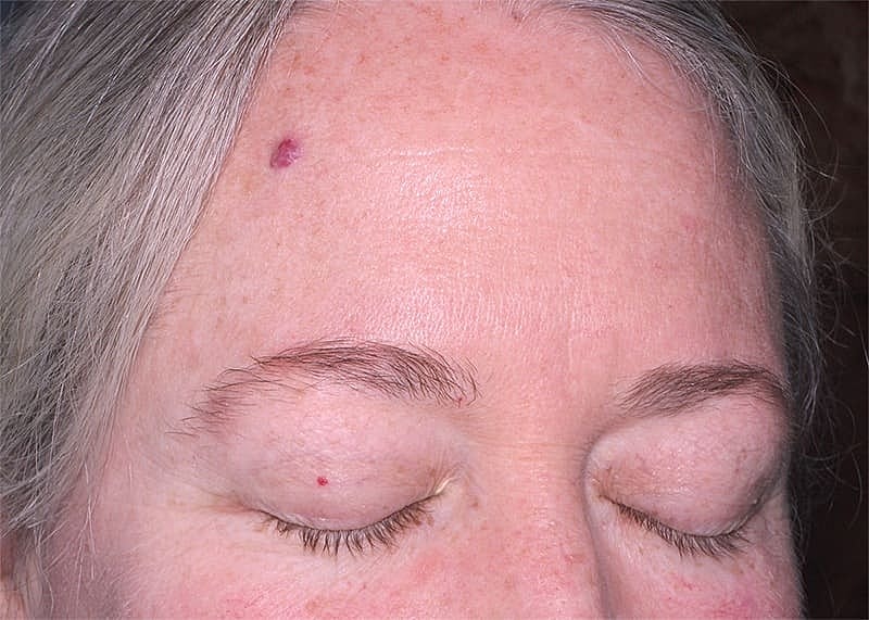 Clear V Laser Before & After