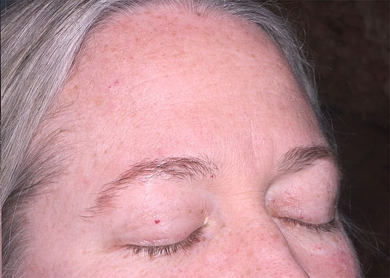 Clear V Laser Before & After