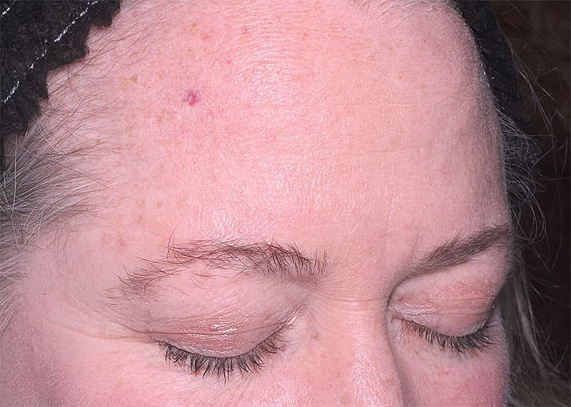 Clear V Laser Before & After