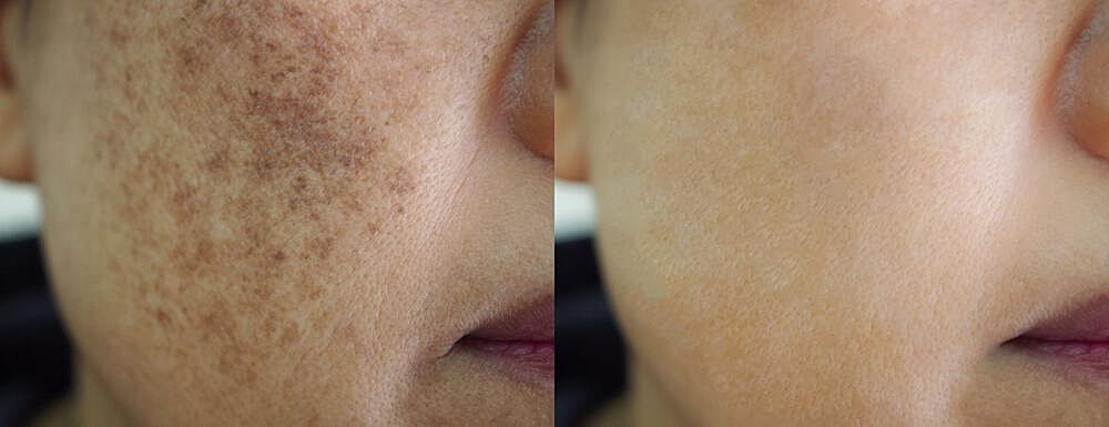 Melasma Treatment Before & After