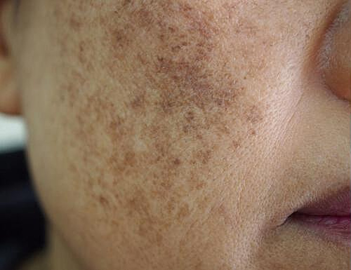 Melasma Treatment Before & After