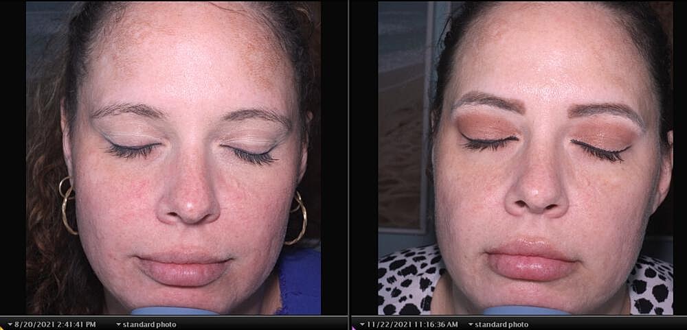 Bbl Hero Before & After