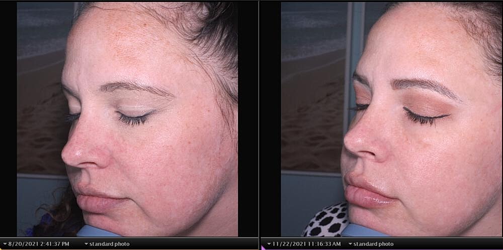 Bbl Hero Before & After