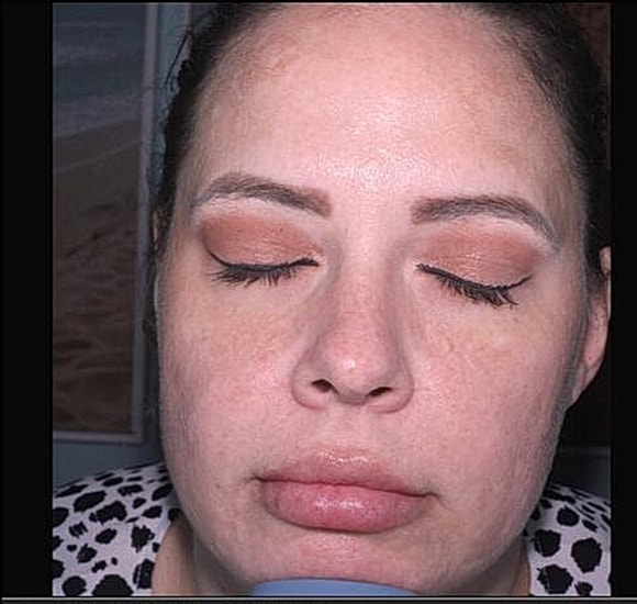 BBL Hero Before & After