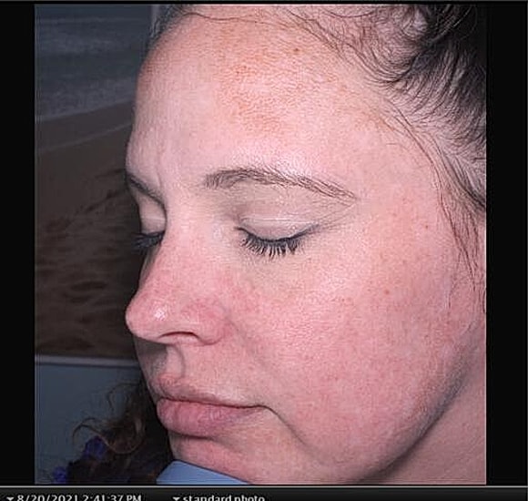 BBL Hero Before & After