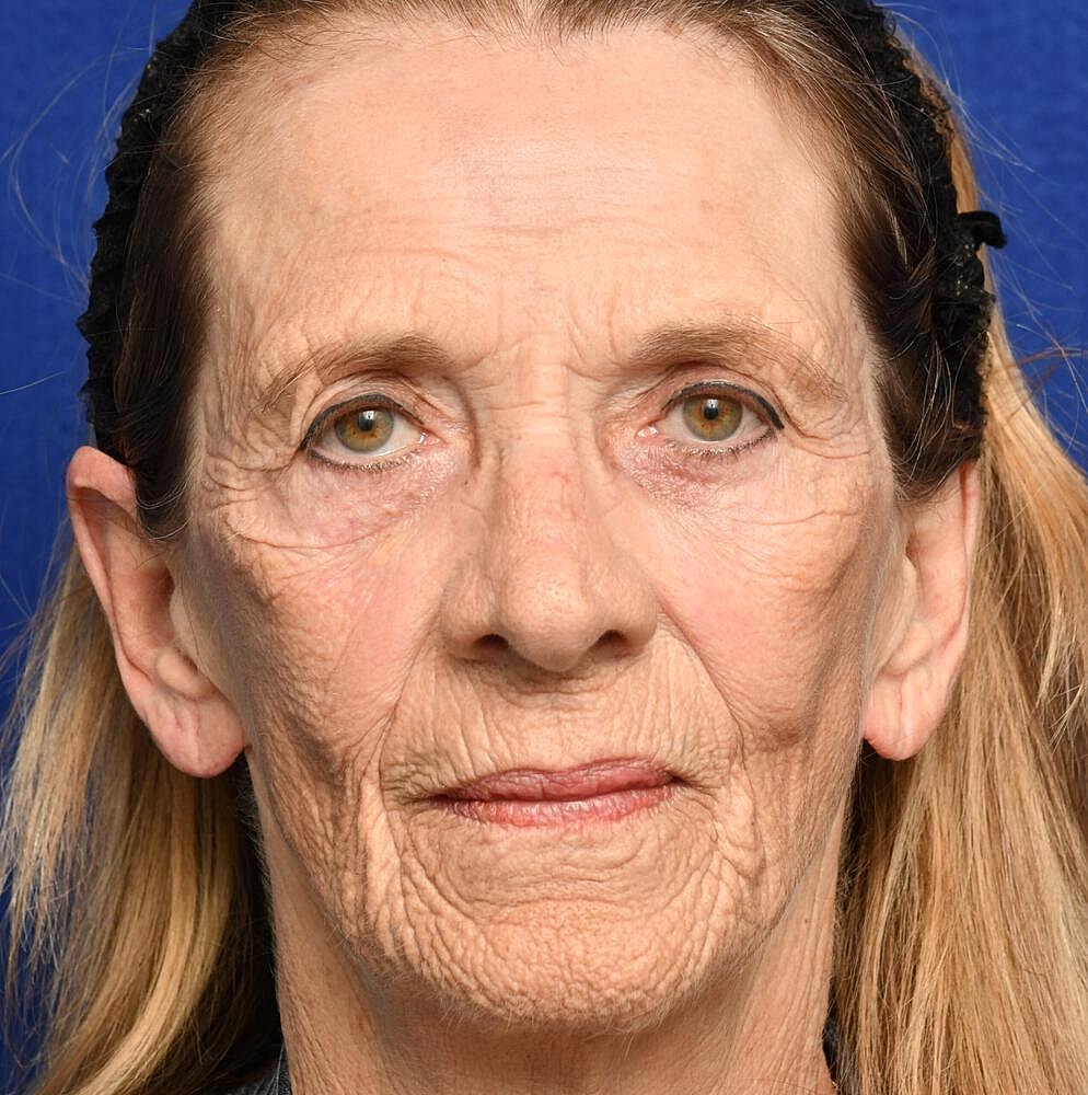 Ablative Laser Before & After