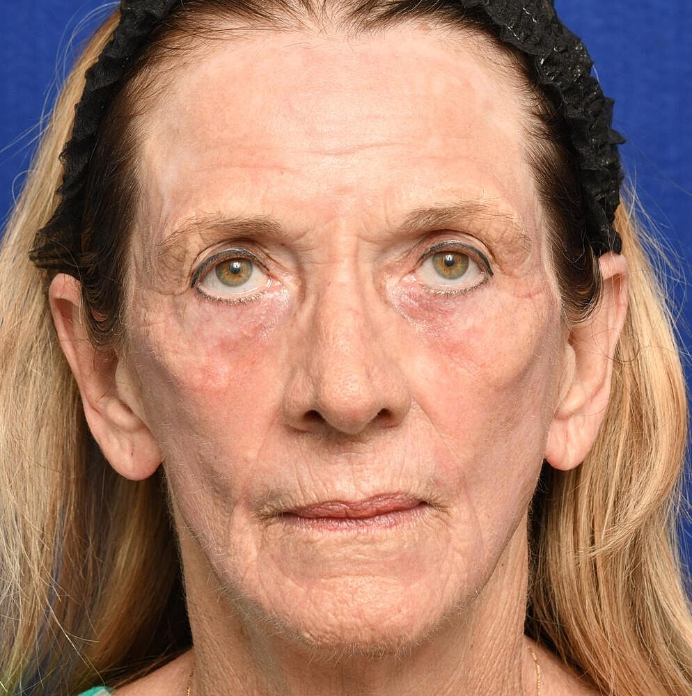 Ablative Laser Before & After