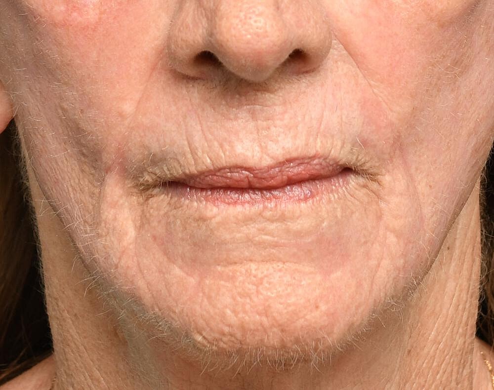 Ablative Laser Before & After