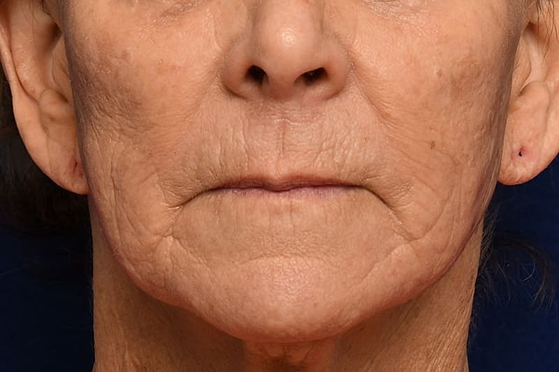 Ablative Laser Before & After