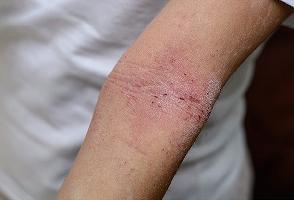 Skin abrasion with redness and irritation on arm.